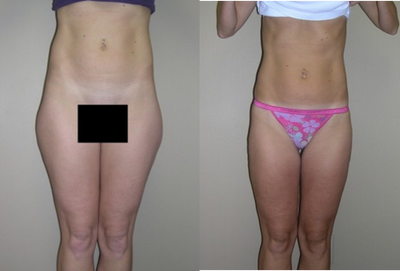 Liposuction before and after photo