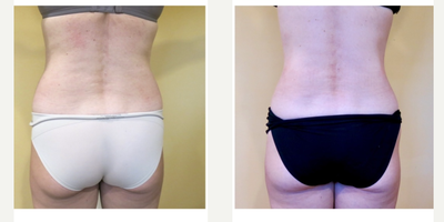 Liposuction before and after photo