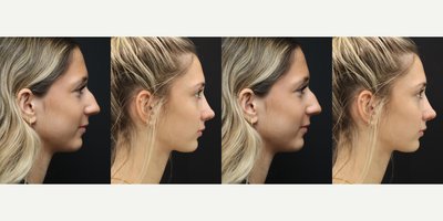Rhinoplasty before and after photo