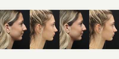 Rhinoplasty before and after photo