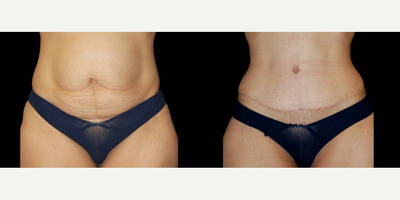 Tummy Tuck before and after photo