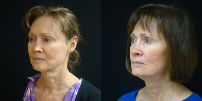 Ultherapy before and after photo