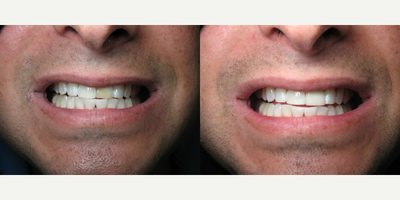 Dental Crown before and after photo