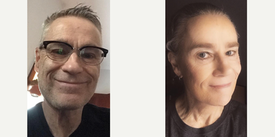 Dermal Fillers before and after photo