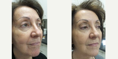 Restylane Lyft before and after photo