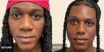 African American Rhinoplasty before and after photo
