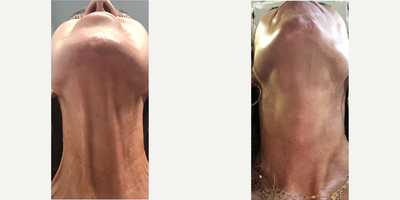 Botox before and after photo