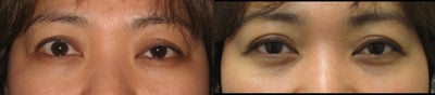 Eyelid Retraction Repair before and after photo