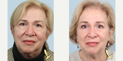 Eyelid Surgery before and after photo