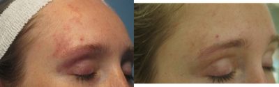 Pulsed Dye Laser before and after photo