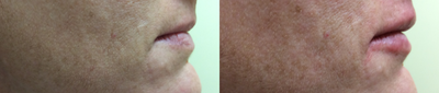 Restylane Silk before and after photo