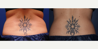 CoolSculpting before and after photo
