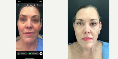 Facelift before and after photo