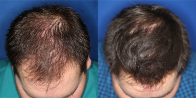 Hair Loss Treatment before and after photo