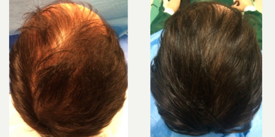 PRP for Hair Loss before and after photo