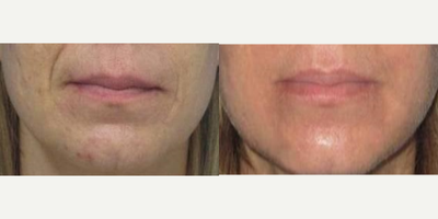Restylane before and after photo