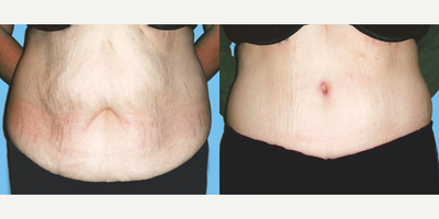 Tummy Tuck before and after photo