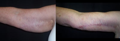 Arm Lift before and after photo