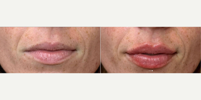 Dermal Fillers before and after photo