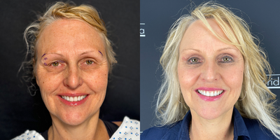 Eyelid Surgery before and after photo