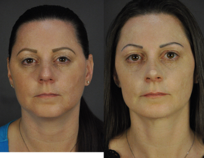 Rhinoplasty before and after photo