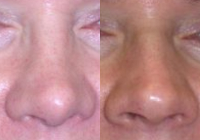Rhinoplasty before and after photo
