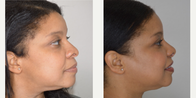African American Rhinoplasty before and after photo