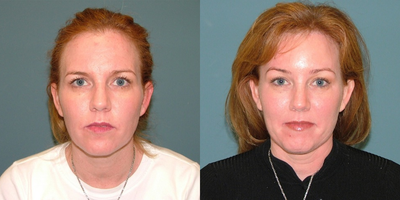 Brow Lift before and after photo
