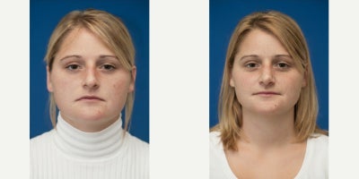 Chin Liposuction before and after photo