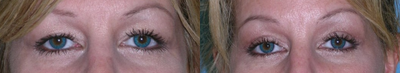 Eyelid Surgery before and after photo