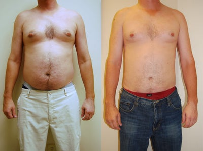 Liposuction before and after photo