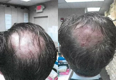 PRP for Hair Loss before and after photo