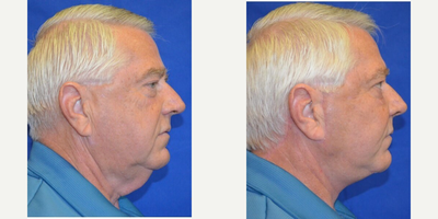 Cheek Augmentation before and after photo