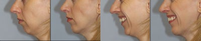 Chin Implant before and after photo