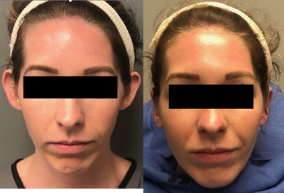Ear Surgery before and after photo