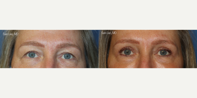 Eyelid Surgery before and after photo