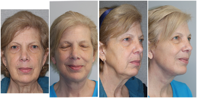 Facelift before and after photo