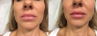 Juvederm before and after photo