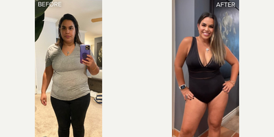 Laser Liposuction before and after photo