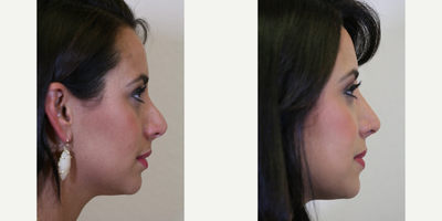 Revision Rhinoplasty before and after photo