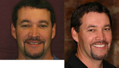 Smile Makeover before and after photo