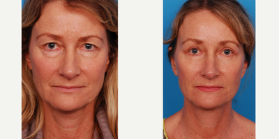 Brow Lift before and after photo