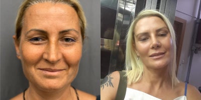 Brow Lift before and after photo
