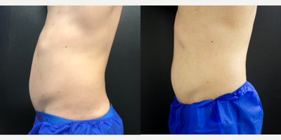 CoolSculpting before and after photo