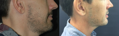 Dermal Fillers before and after photo