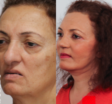 Facelift before and after photo