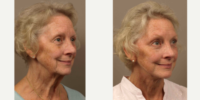 Lower Facelift before and after photo