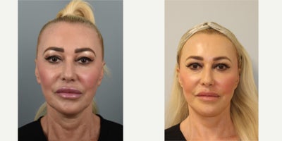 Mini Facelift before and after photo