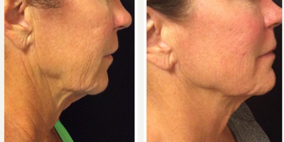 Profound RF before and after photo