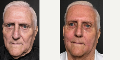 Bellafill before and after photo
